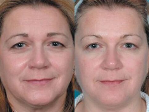 φωτογραφίες πριν και μετά την αναζωογόνηση του δέρματος στο πλάσμα