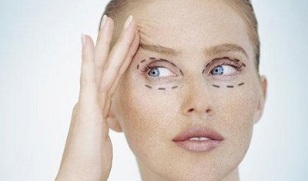 τύποι βλεφαροπλαστικής για την αναζωογόνηση του δέρματος γύρω από τα μάτια