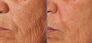 φωτογραφία πριν και μετά την κλασματική αναζωογόνηση του δέρματος
